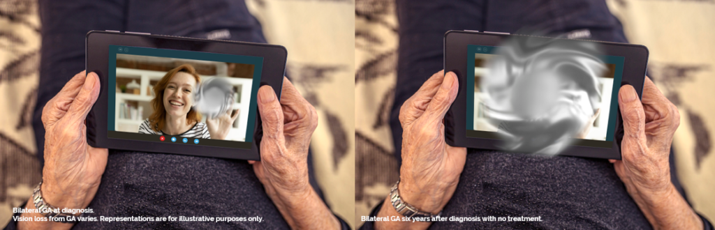 Alternative views of photo through the eyes of patient without and with GA.
